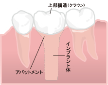 インプラント