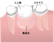 義歯（入れ歯）