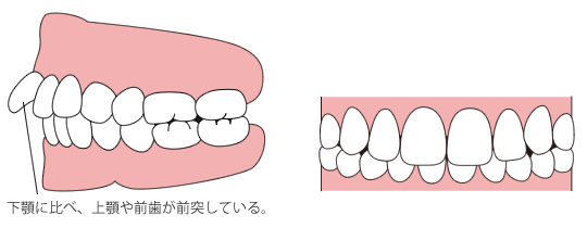 上顎前突(じょうがくぜんとつ)