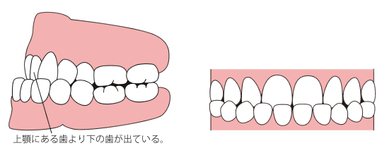 下顎前突(かがくぜんとつ)