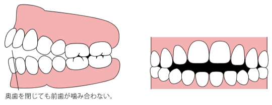 開咬(かいこう)